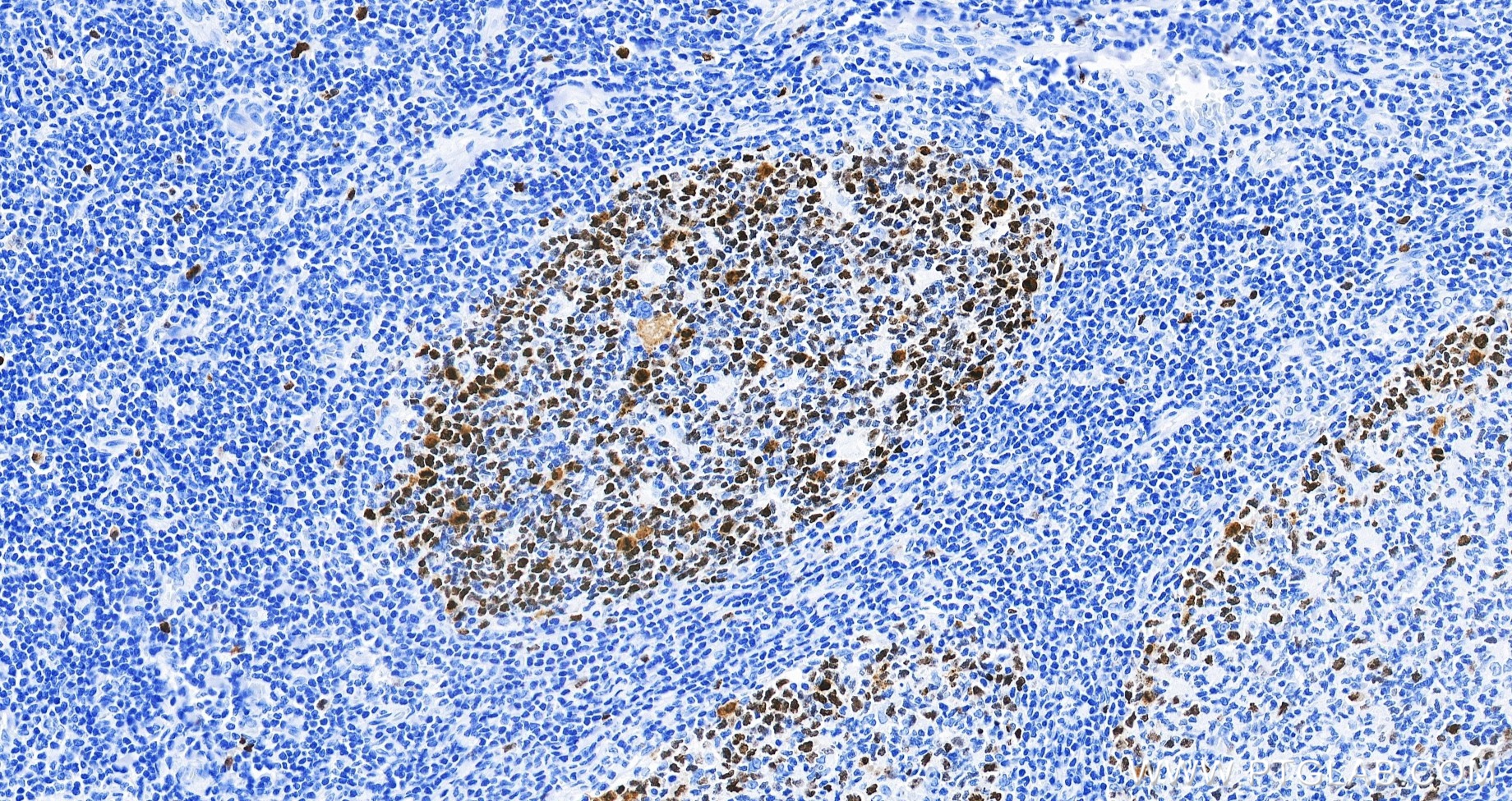 IHC staining of human tonsillitis using 82738-10-RR IHC staining of human tonsillitis using 82738-10-RR