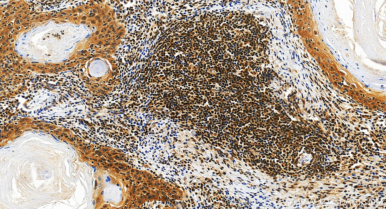 IHC staining of human skin cancer using RMX00047 IHC staining of human skin cancer using RMX00047