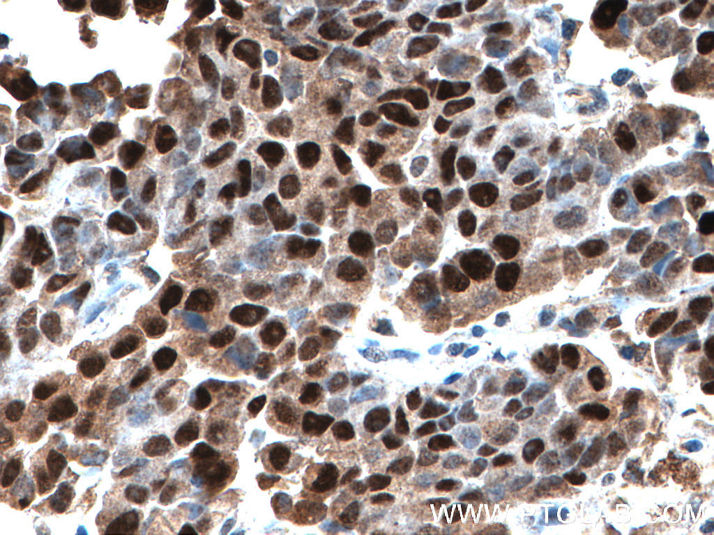 IHC staining of human prostate cancer using 21891-1-AP