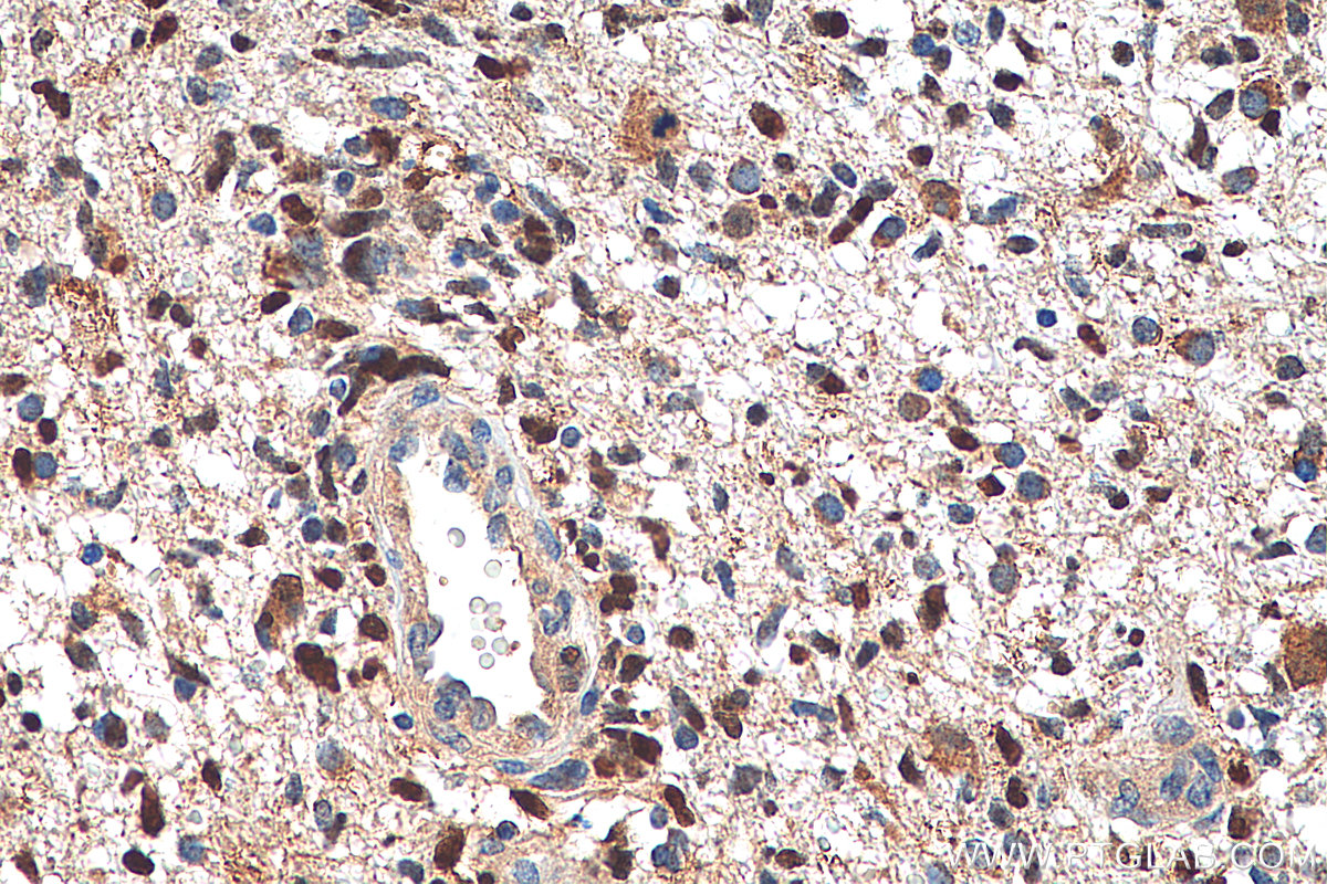 IHC staining of human gliomas using 21891-1-AP