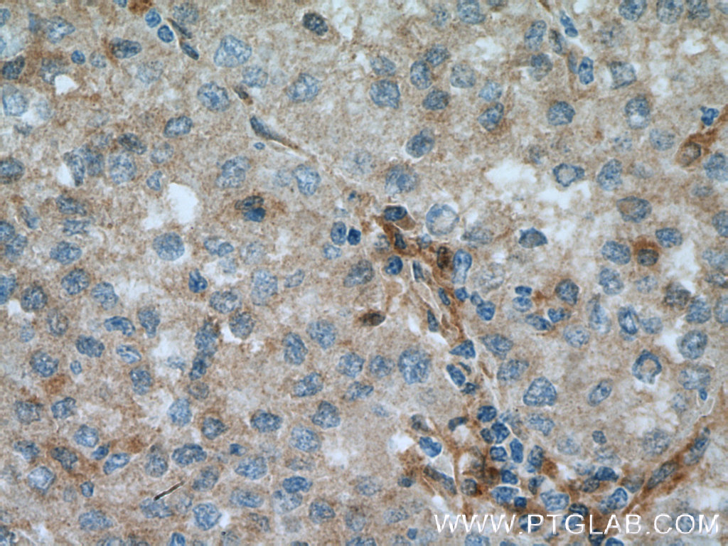 IHC staining of human liver cancer using 14828-1-AP