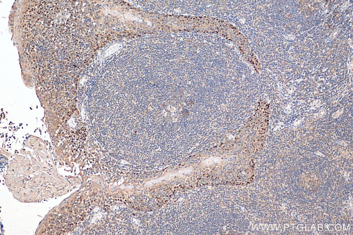 IHC staining of human tonsillitis using 12143-1-AP