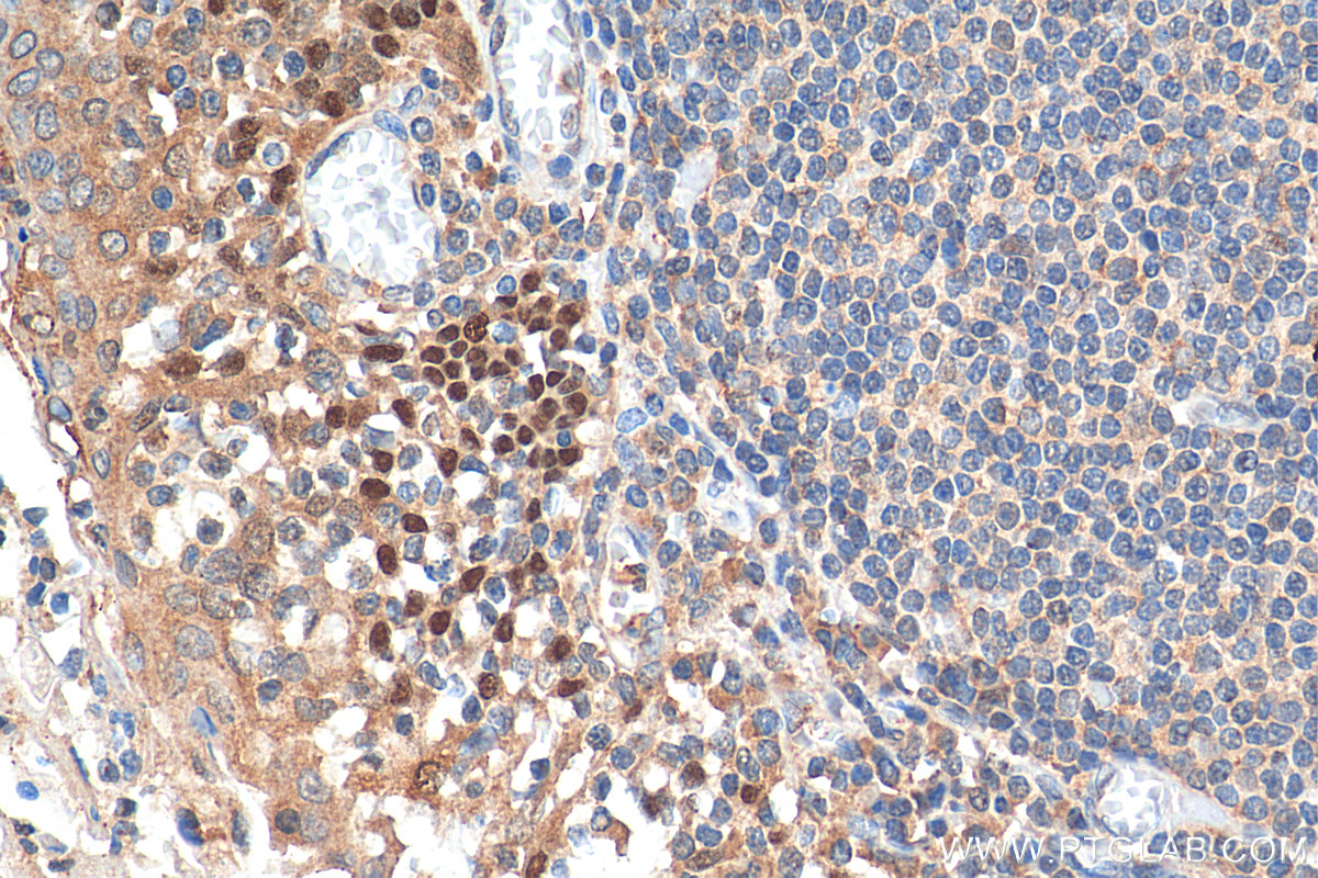 IHC staining of human tonsillitis using 12143-1-AP