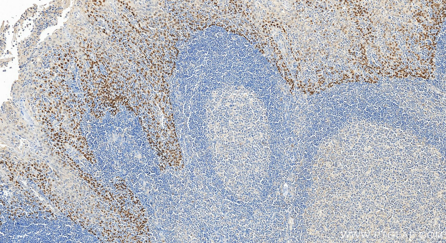 IHC staining of human tonsillitis using 12143-1-AP