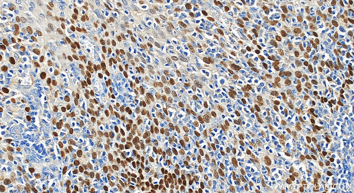 Immunohistochemical analysis of paraffin-embedded human tonsillitis tissue slide using 12143-1-AP (p63 antibody) at dilution of 1:4000 (under 20x lens). Heat mediated antigen retrieval with Tris-EDTA buffer (pH 9.0). IHC staining of human tonsillitis using 12143-1-AP