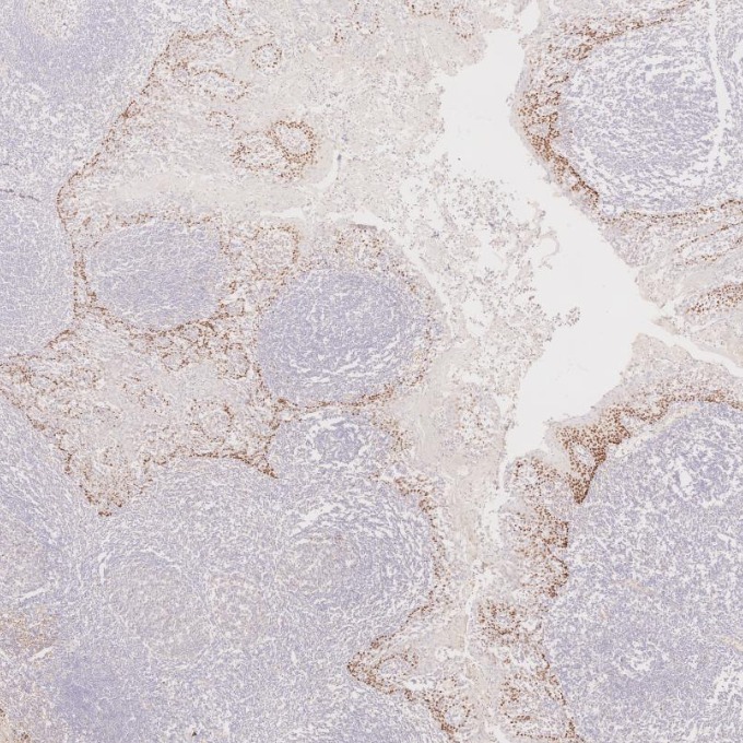 IHC staining of human tonsillitis using 60332-2-Ig IHC staining of human tonsillitis using 60332-2-Ig