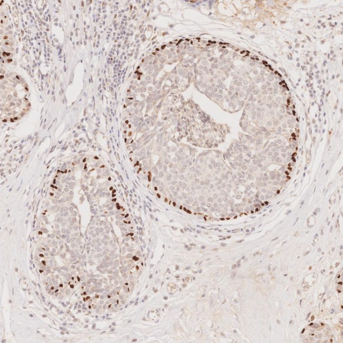 IHC staining of human breast cancer using 60332-2-Ig IHC staining of human breast cancer using 60332-2-Ig