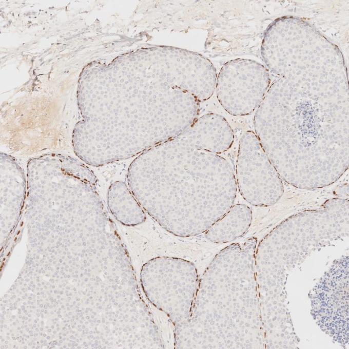 IHC staining of human breast cancer using 60332-2-Ig IHC staining of human breast cancer using 60332-2-Ig