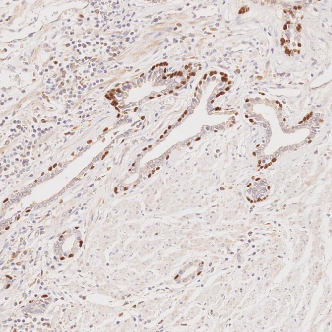 IHC staining of human prostate cancer using 60332-2-Ig IHC staining of human prostate cancer using 60332-2-Ig