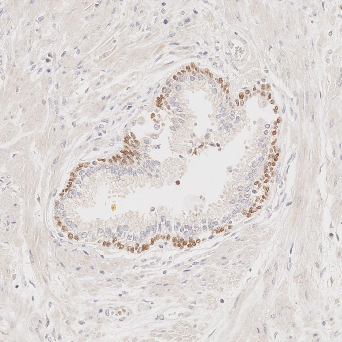 IHC staining of human prostate cancer using 60332-2-Ig IHC staining of human prostate cancer using 60332-2-Ig