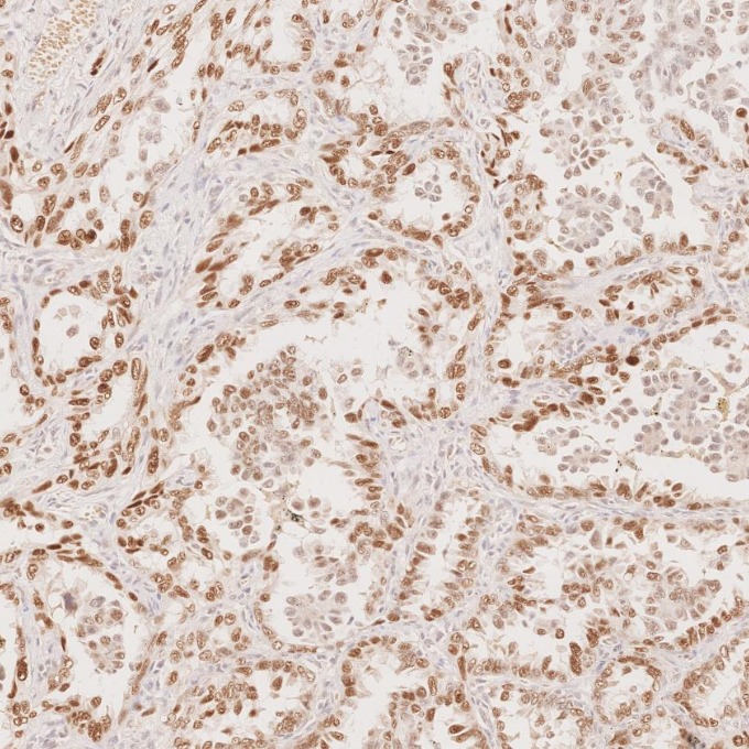IHC staining of human lung cancer using 60332-2-Ig IHC staining of human lung cancer using 60332-2-Ig