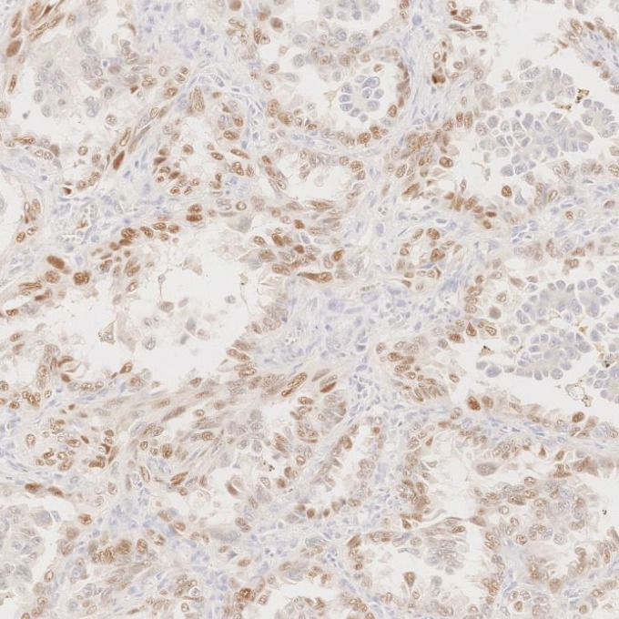 IHC staining of human lung cancer using 60332-2-Ig IHC staining of human lung cancer using 60332-2-Ig