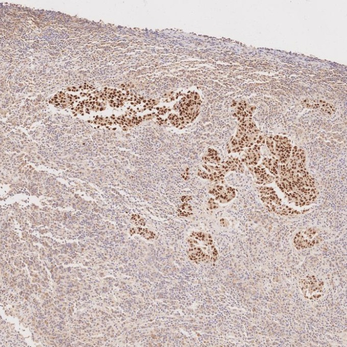 IHC staining of human nasopharyngeal carcinoma using 60332-2-Ig IHC staining of human nasopharyngeal carcinoma using 60332-2-Ig