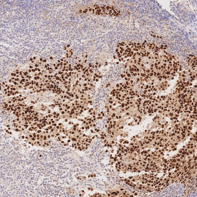 IHC staining of human nasopharyngeal carcinoma using 86154-1-RR IHC staining of human nasopharyngeal carcinoma using 86154-1-RR
