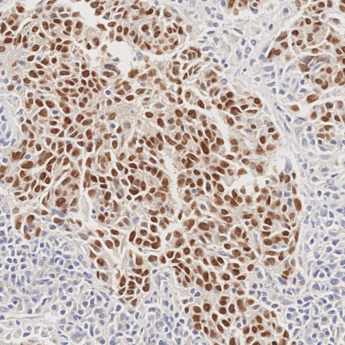 IHC staining of human nasopharyngeal carcinoma using 86154-1-RR IHC staining of human nasopharyngeal carcinoma using 86154-1-RR