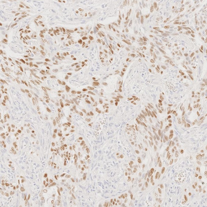 IHC staining of human lung cancer using 86154-1-RR IHC staining of human lung cancer using 86154-1-RR