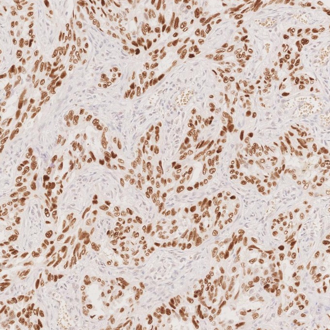 IHC staining of human lung cancer using 86154-1-RR IHC staining of human lung cancer using 86154-1-RR