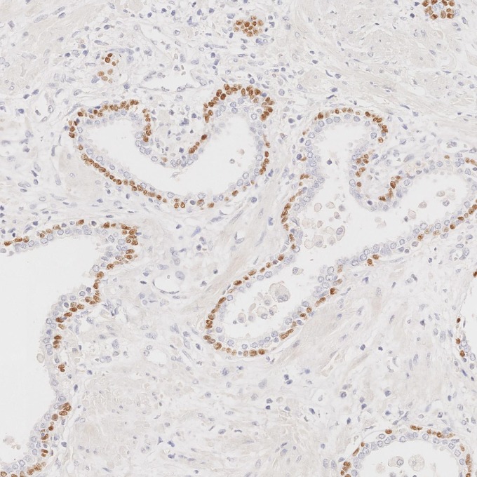 IHC staining of human prostate cancer using 86154-1-RR IHC staining of human prostate cancer using 86154-1-RR