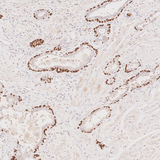 IHC staining of human prostate cancer using 86154-1-RR IHC staining of human prostate cancer using 86154-1-RR