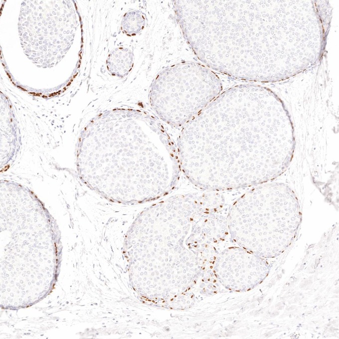 IHC staining of human breast cancer using 86154-1-RR IHC staining of human breast cancer using 86154-1-RR