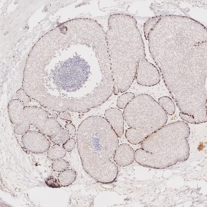 IHC staining of human breast cancer using 86154-1-RR IHC staining of human breast cancer using 86154-1-RR