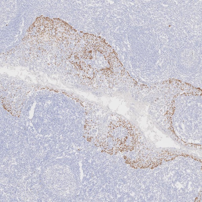 IHC staining of human tonsillitis using 86154-1-RR IHC staining of human tonsillitis using 86154-1-RR