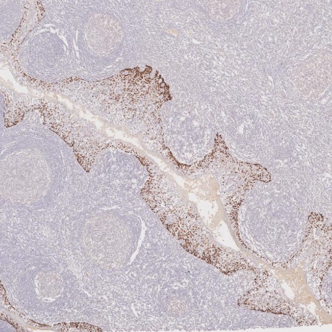 IHC staining of human tonsillitis using 86154-1-RR IHC staining of human tonsillitis using 86154-1-RR