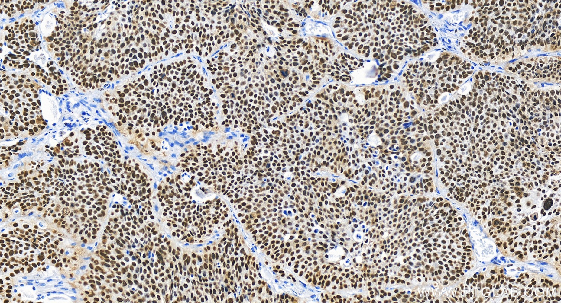 IHC staining of human lung cancer using 86154-1-RR (same clone as 86154-1-PBS)