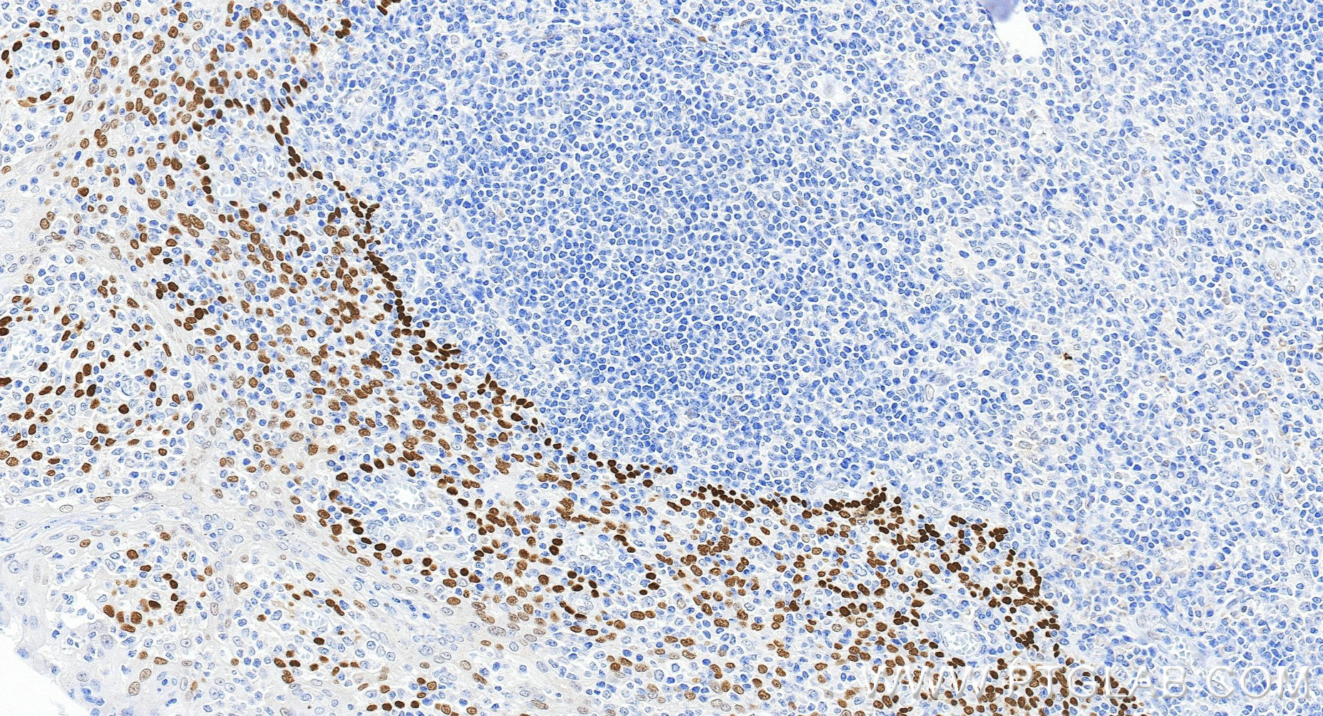 IHC staining of human tonsillitis using 86154-1-RR