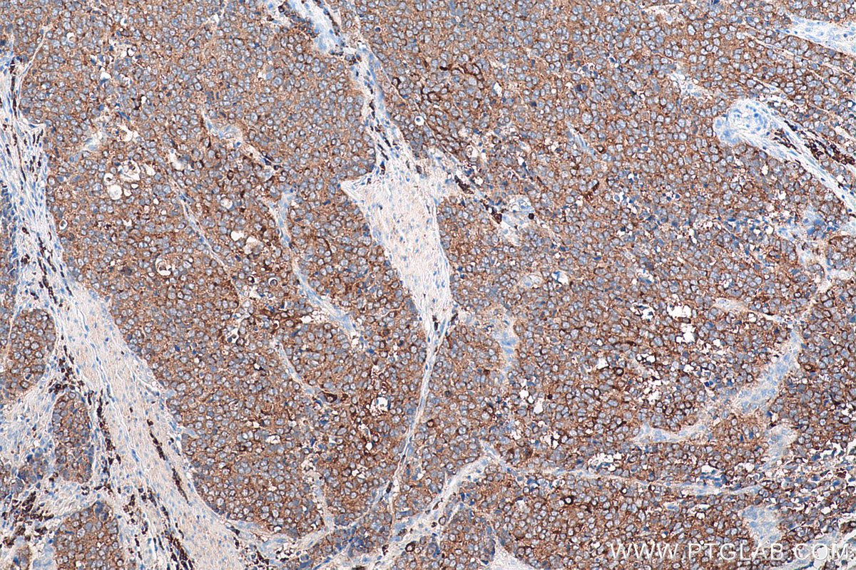 IHC staining of human stomach cancer using 27648-1-AP (same clone as 27648-1-PBS)