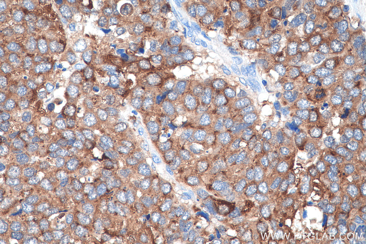 IHC staining of human stomach cancer using 27648-1-AP (same clone as 27648-1-PBS)