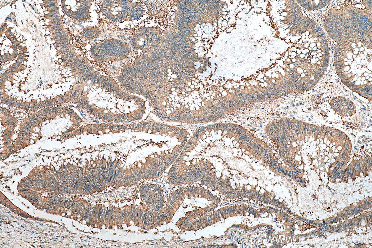 Immunohistochemical analysis of paraffin-embedded human colon cancer tissue slide using 14732-1-AP (hD53; TPD52L1 antibody) at dilution of 1:200 (under 10x lens). Heat mediated antigen retrieval with Tris-EDTA buffer (pH 9.0). IHC staining of human colon cancer using 14732-1-AP