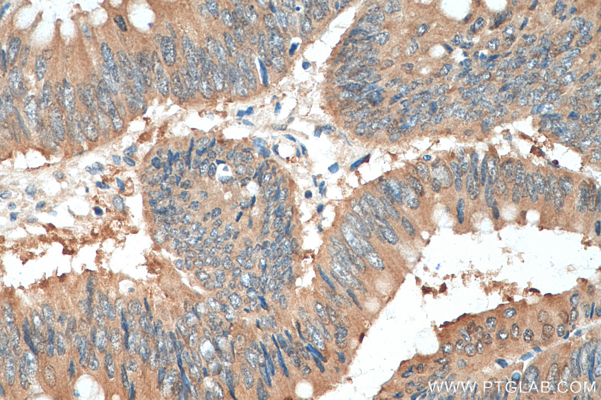Immunohistochemical analysis of paraffin-embedded human colon cancer tissue slide using 14732-1-AP (hD53; TPD52L1 antibody) at dilution of 1:200 (under 40x lens). Heat mediated antigen retrieval with Tris-EDTA buffer (pH 9.0). IHC staining of human colon cancer using 14732-1-AP