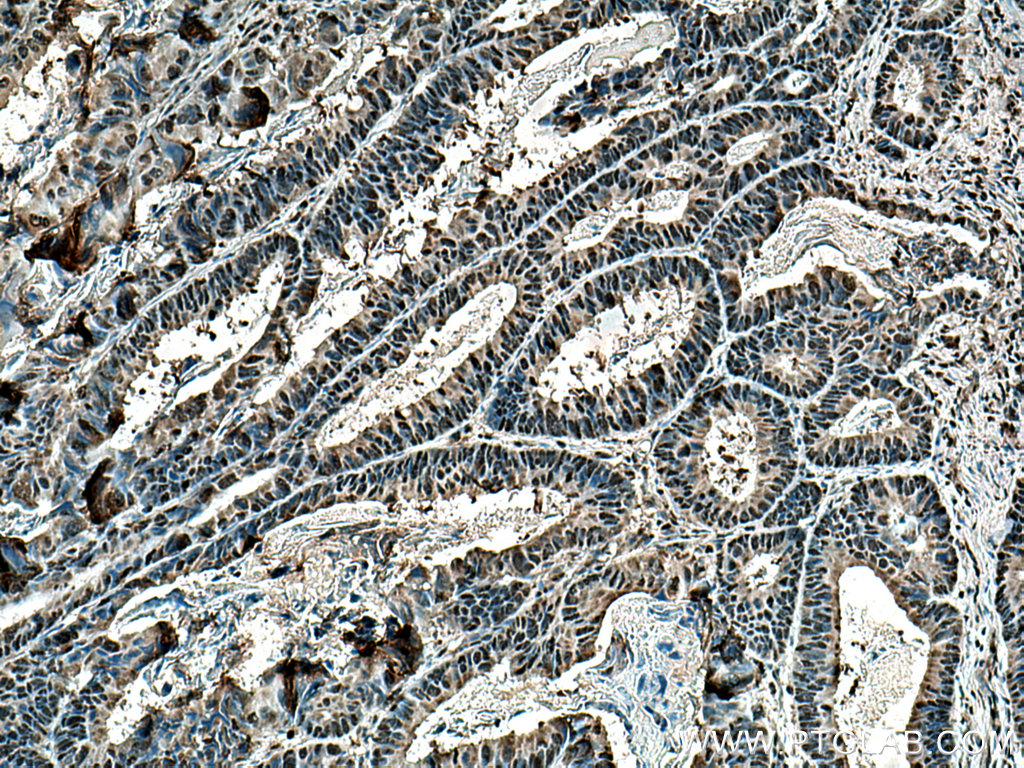 IHC staining of human colon cancer using 10713-1-AP