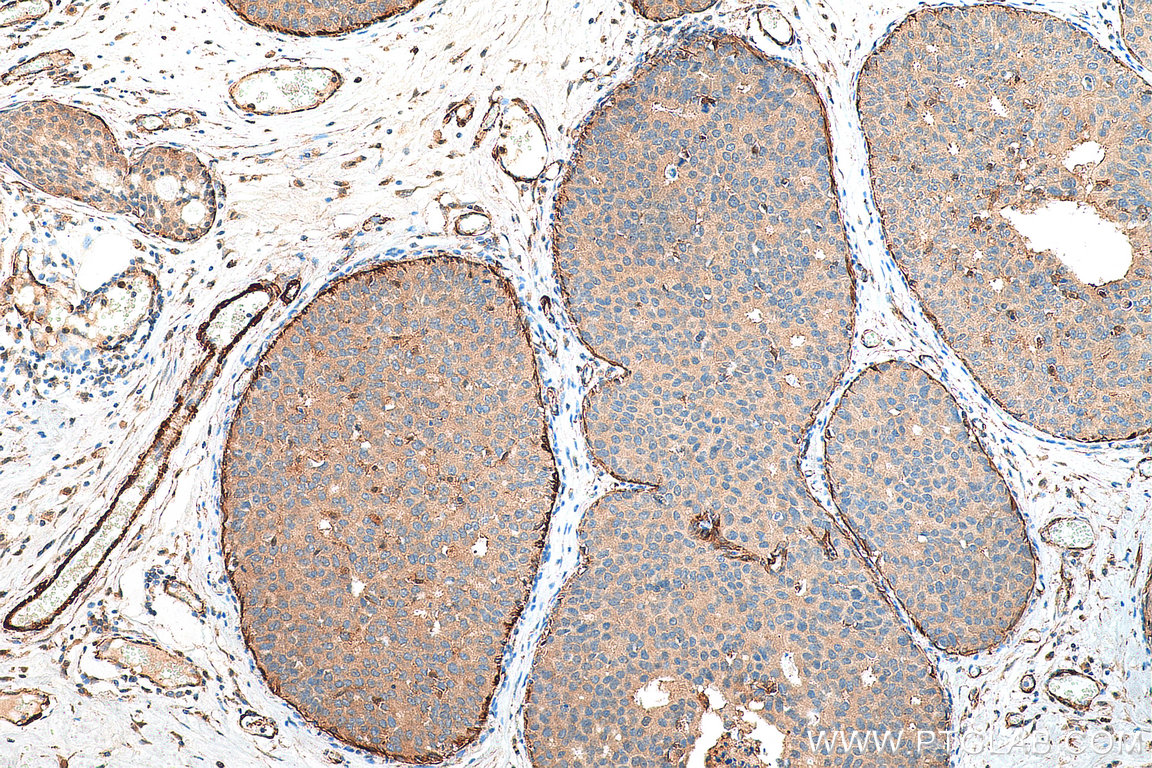 IHC staining of human breast cancer using 11038-1-AP
