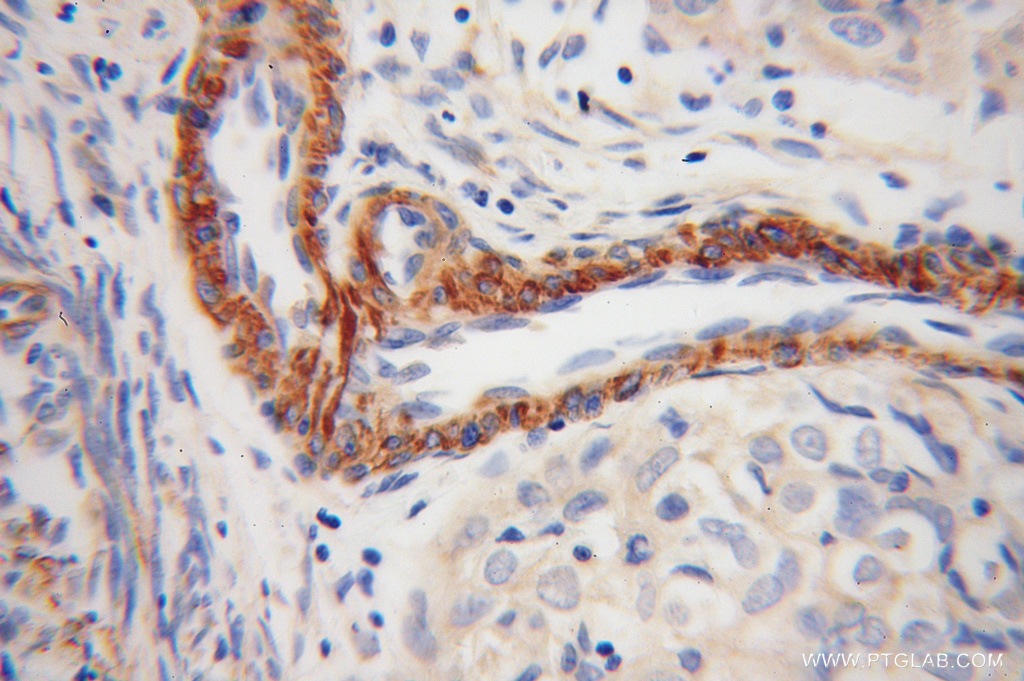 IHC staining of human endometrial cancer using 13741-1-AP