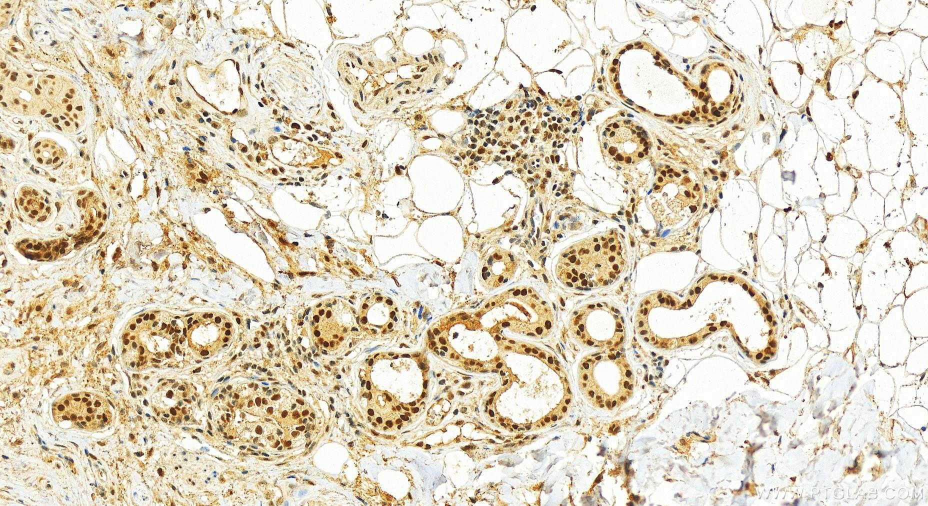 IHC staining of human skin cancer using 66402-1-Ig