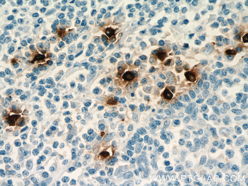 IHC staining of human tonsillitis using 66174-1-Ig