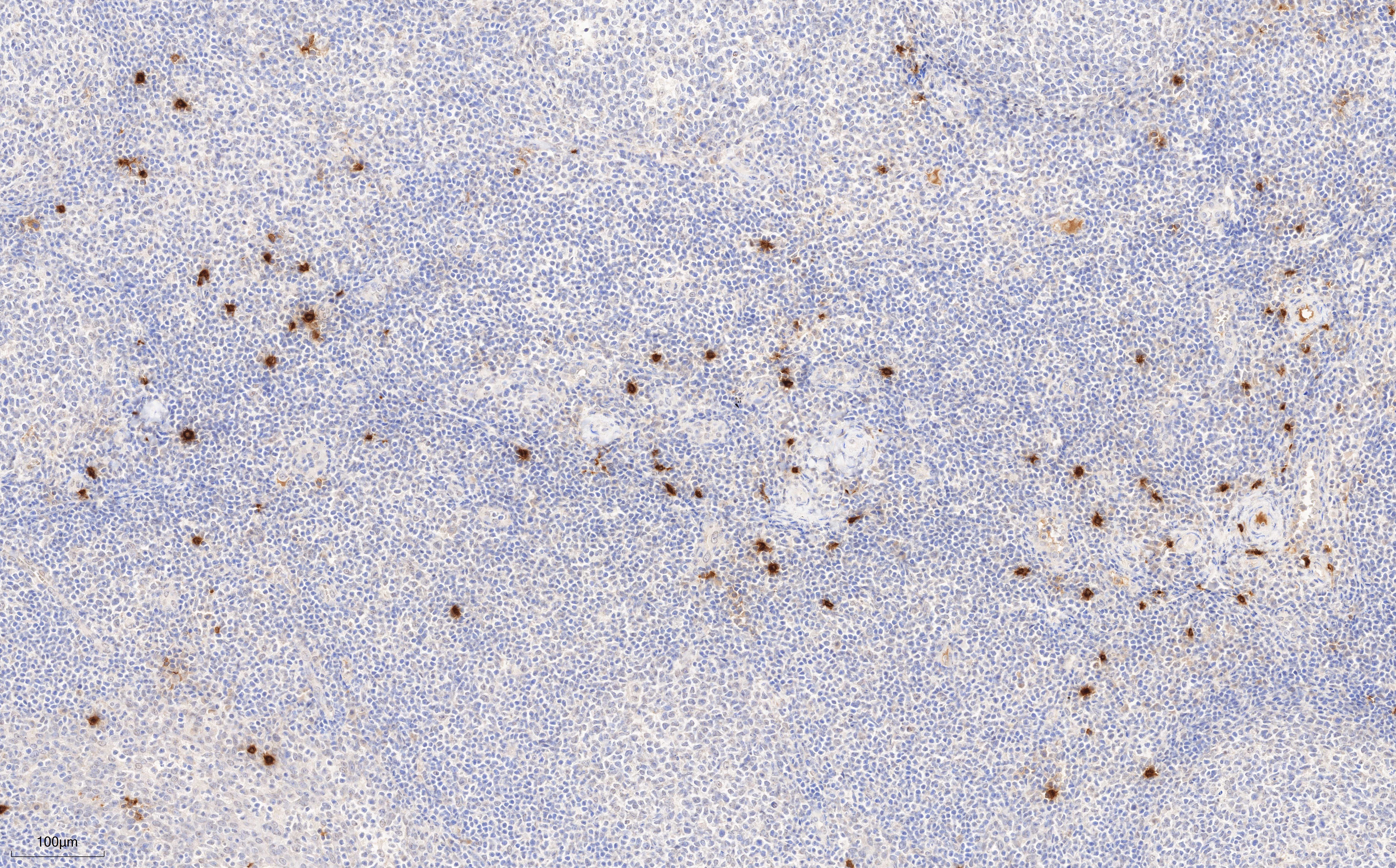 IHC staining of human tonsillitis using 66174-1-Ig