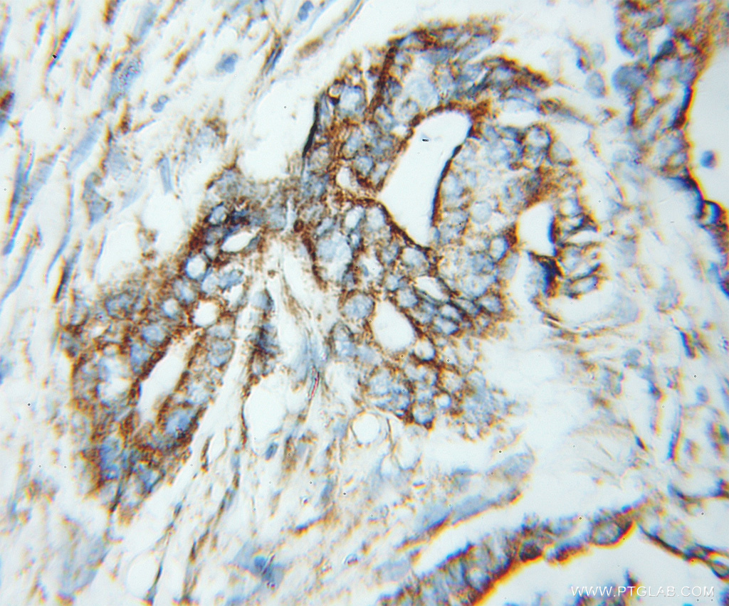 IHC staining of human pancreas cancer using 11699-1-AP