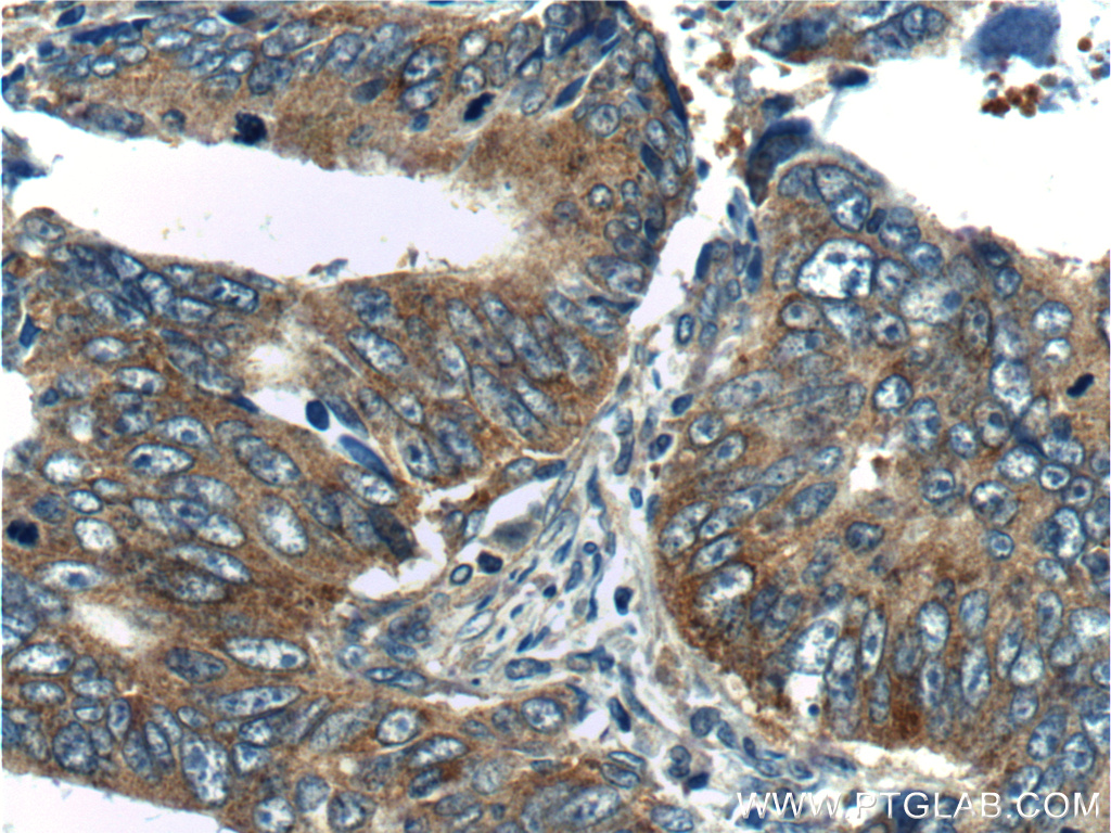 IHC staining of human colon cancer using 10824-1-AP