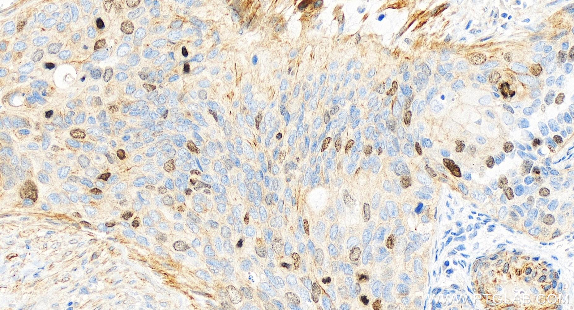 IHC staining of human cervical cancer using 85118-6-RR (same clone as 85118-6-PBS)