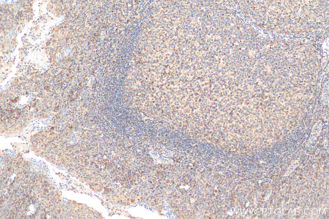 IHC staining of human tonsillitis using 11890-1-AP (same clone as 11890-1-PBS)