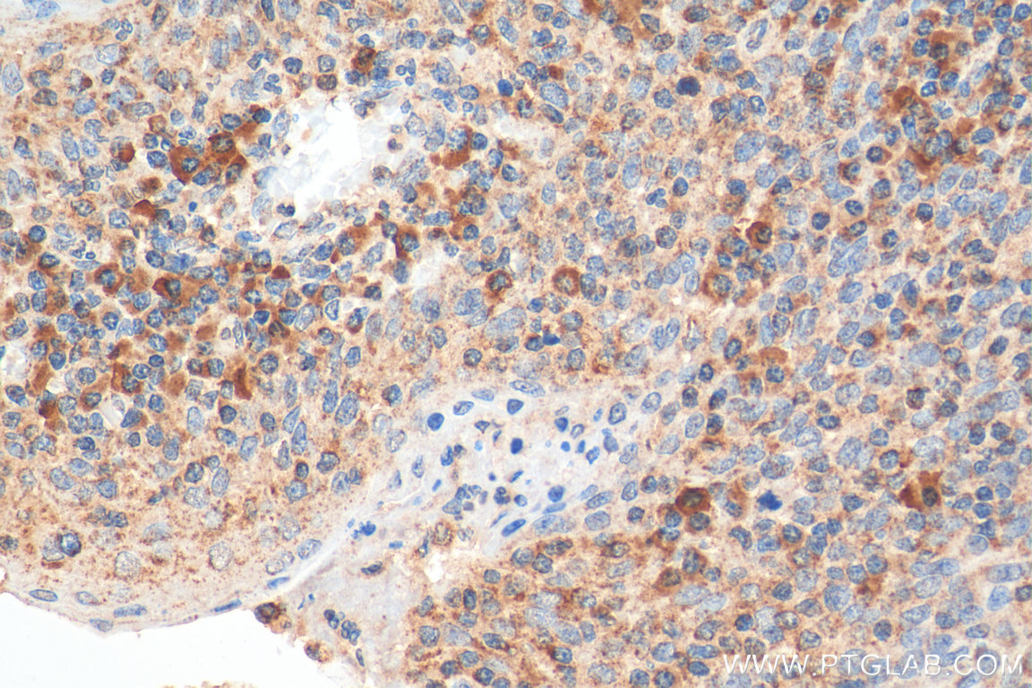 IHC staining of human tonsillitis using 11890-1-AP