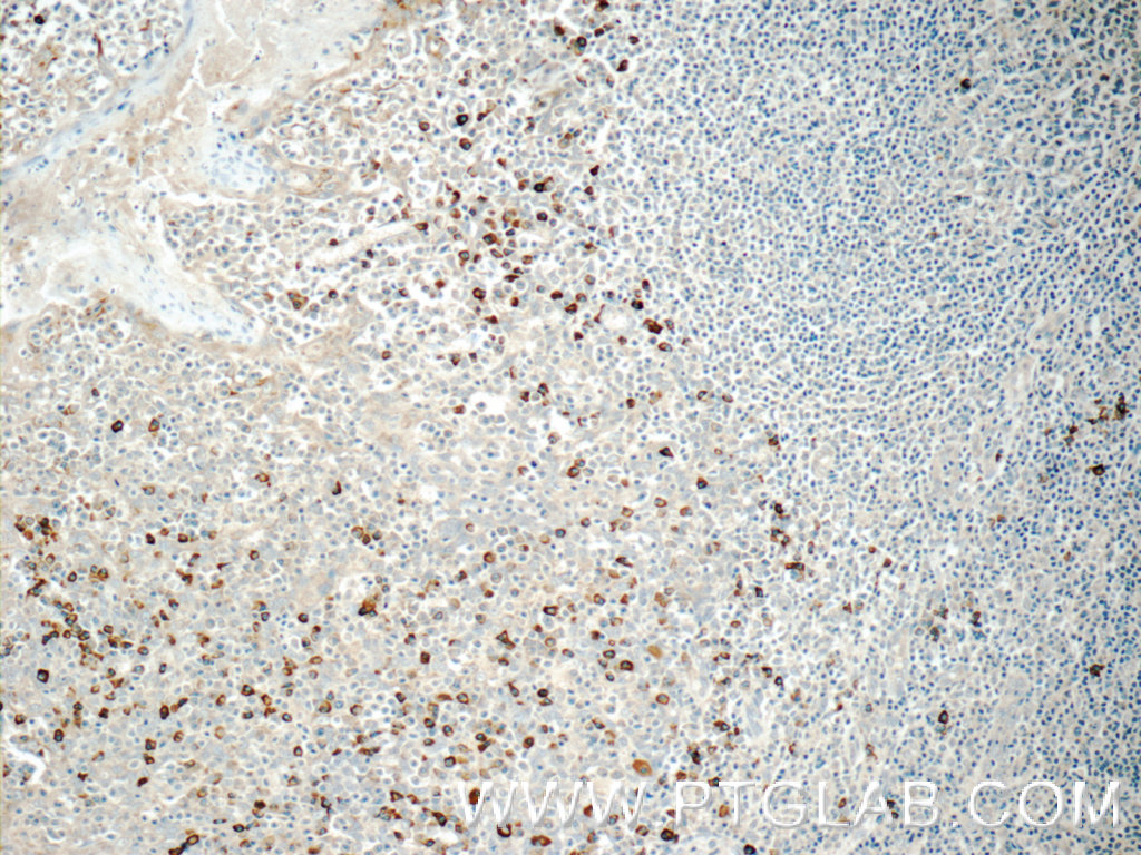 IHC staining of human tonsillitis using 11890-1-AP (same clone as 11890-1-PBS)