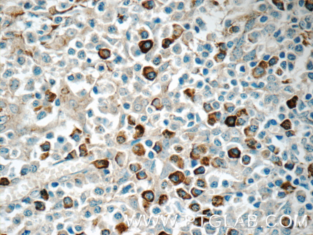 IHC staining of human tonsillitis using 11890-1-AP (same clone as 11890-1-PBS)