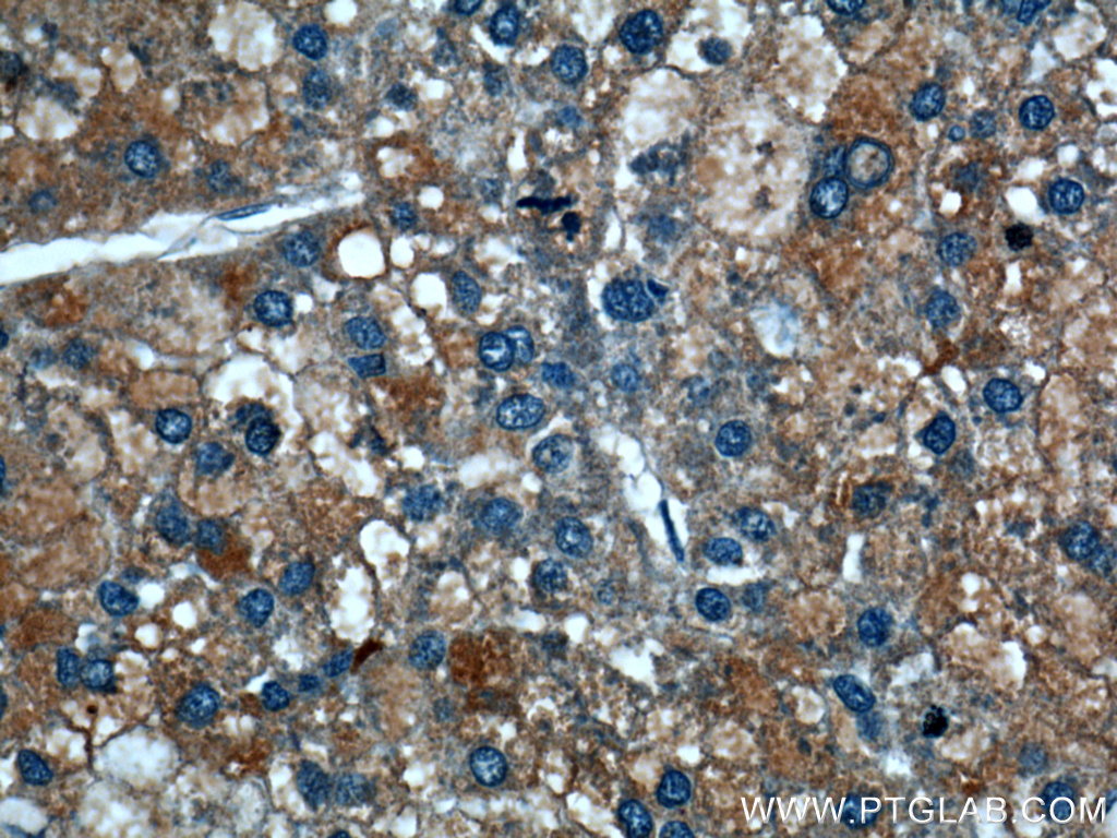 IHC staining of human liver cancer using 26846-1-AP