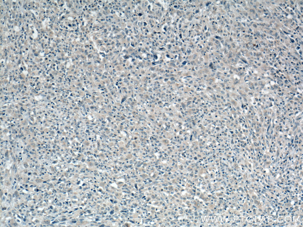IHC staining of human lymphoma using 66310-1-Ig (same clone as 66310-1-PBS)