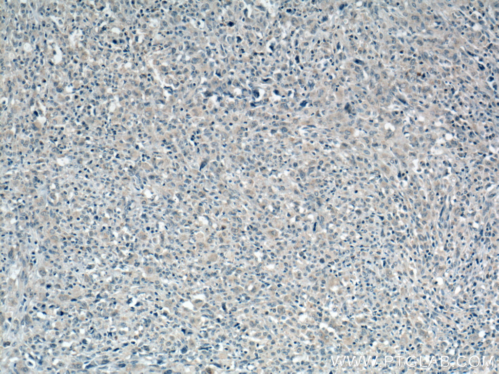 IHC staining of human lymphoma using 66310-1-Ig