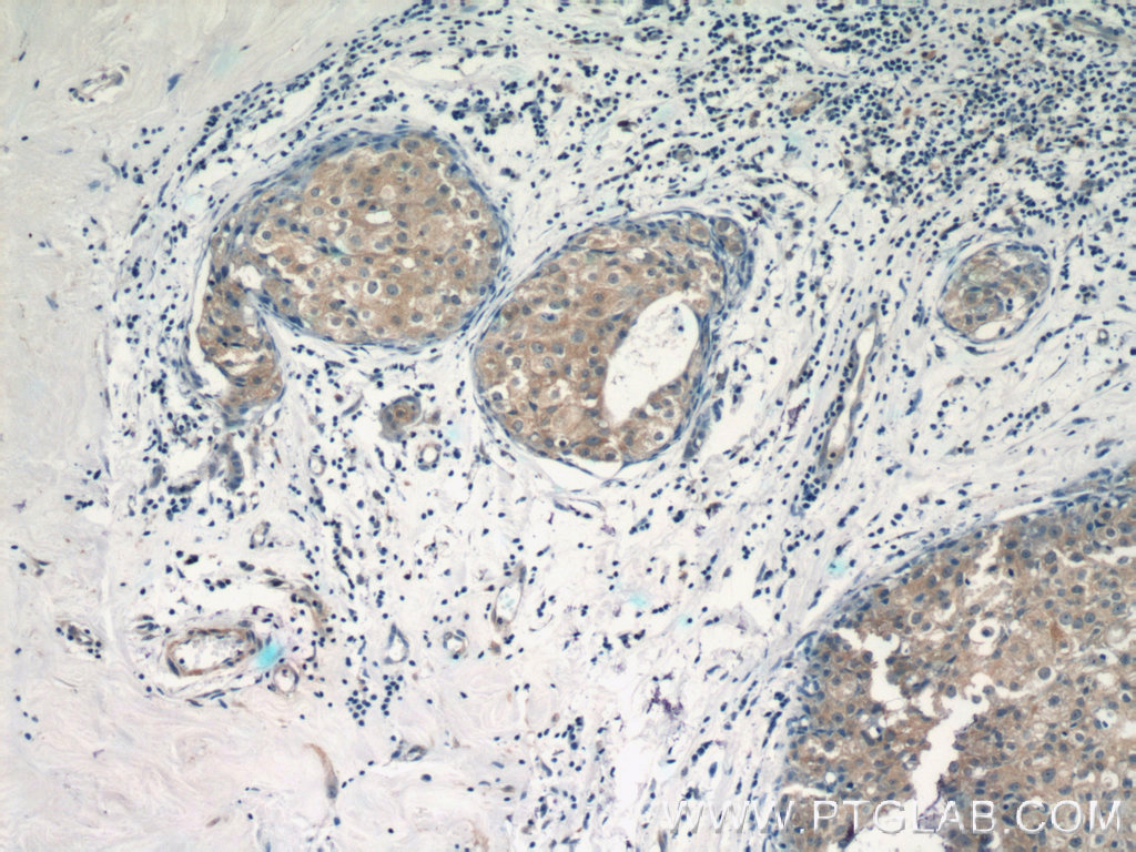 IHC staining of human breast cancer using 14404-1-AP